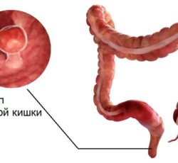 Опухоль в прямой кишке