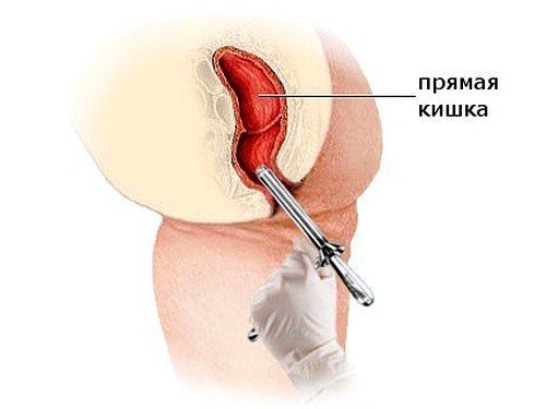 Диагностика геморроя аноскопией