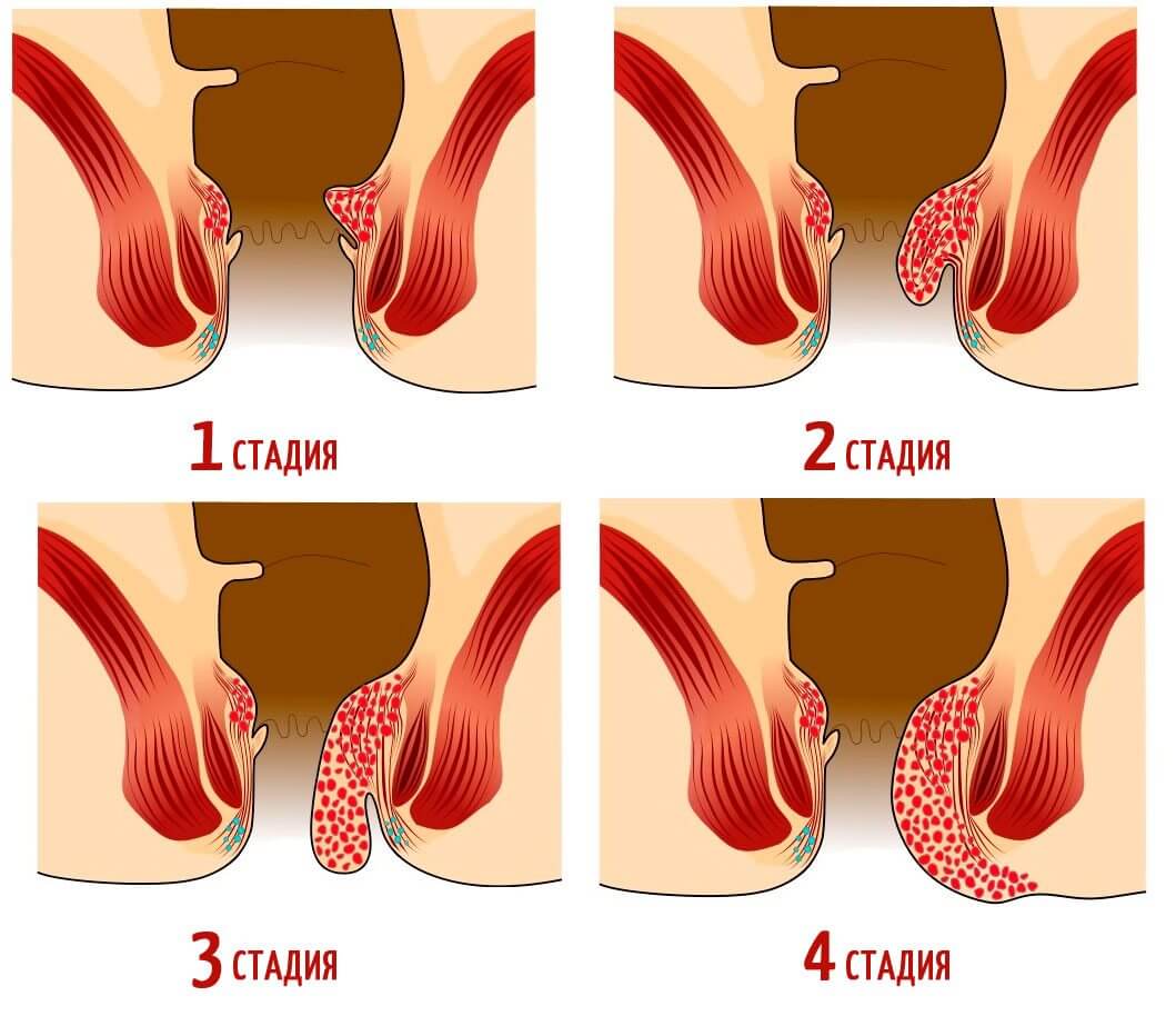 Как различить стадии геморроя?
