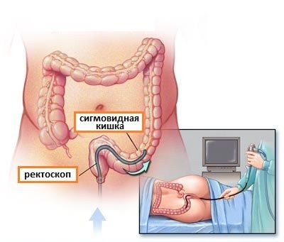 Что такое ректосигмоколоноскопия