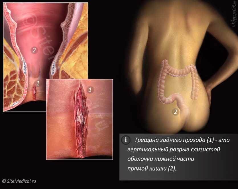 Опасность геморроя