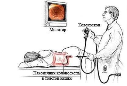 Колоноскопия
