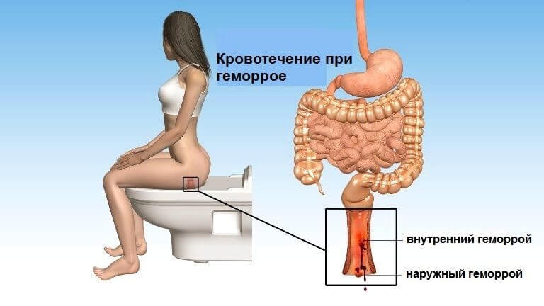 Причины геморроидального кровотечения и его последствия
