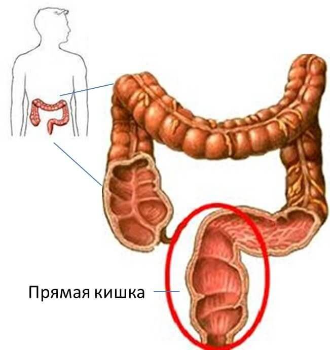 Колит