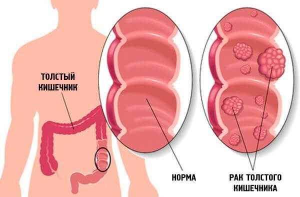 Рак толстой кишки
