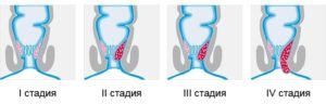 стадии геморроя