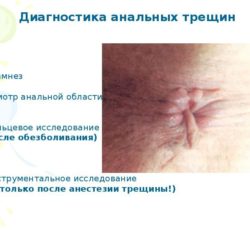 Диагностика анальных трещин