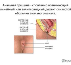 Что такое анальная трещина