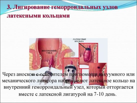 Лигирование латексными кольцами