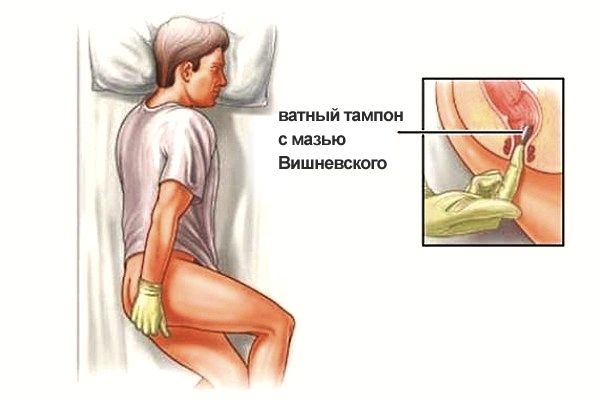 Установка ватного тампона