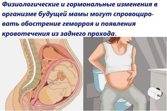 Причины кровотечения из заднего прохода у беременных