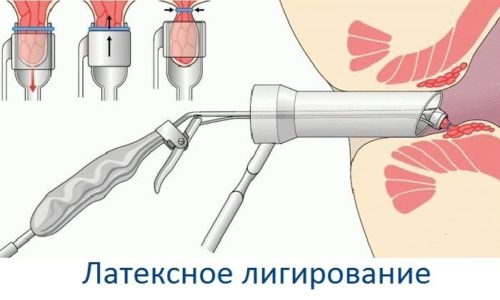 Наложение эластичного кольца пациенту, лежащему на гинекологическом кресле, выполняют механическим лигатором