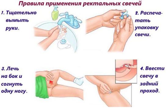 Правила применения ректальных свечей
