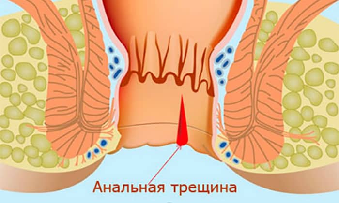 Острая анальная трещина: причины, симптомы и лечение