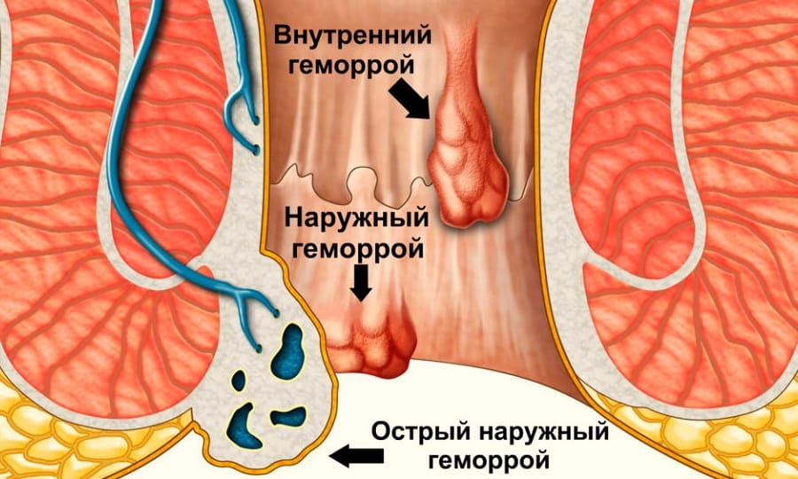 Внутренний геморрой часто диагностируется уже в запущенной форме, поскольку первые тревожные симптомы пациентки игнорируют