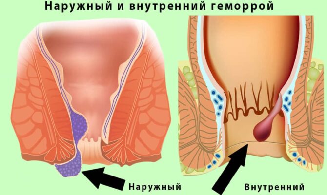 Как и чем лечить наружный геморрой у женщин?