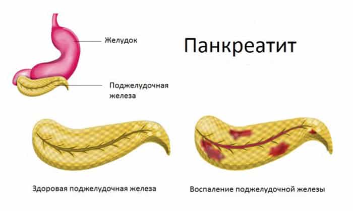 К наиболее распространенным причинам возникновения диареи можно отнести хронический панкреатит