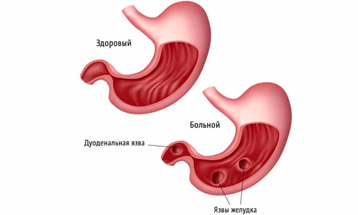 Использование овоща и блюд из него в пищу противопоказано при язве желудка