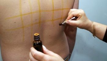 Для чего делают йодовую сетку и как правильно нарисовать на теле